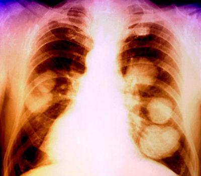 Rakovina plicní metastázy, kolik žije