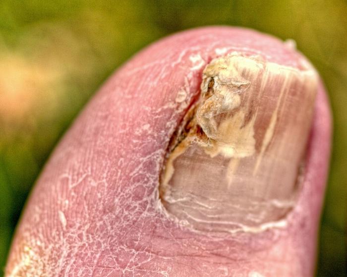 Účinné ošetření nehtové houby na nohou s lidovými prostředky